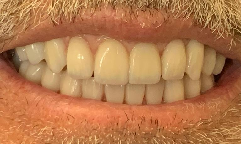 All-on-4-Dental-Implants-After-Image