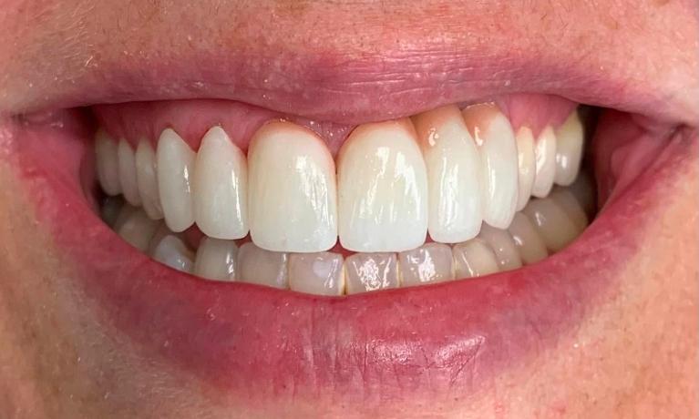 Ceramic-Crowns-After-Image