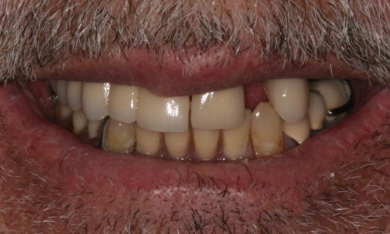 All-on-4-Dental-Implants-Before-Image