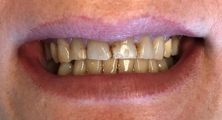 Ceramic-Crowns-Before-Image