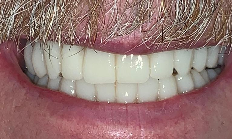 All-on-4-Dental-Implants-After-Image