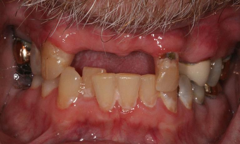 All-on-4-Dental-Implants-Before-Image